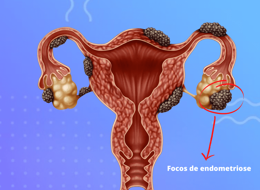 Endometriose e Inflamação Crônica: A Conexão Que Você Precisa Entender para o Alívio e Bem-Estar