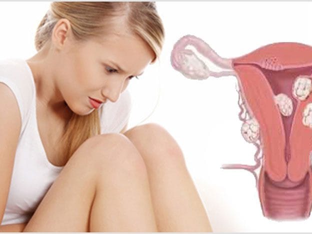 Desvendando os Miomas Uterinos: Entenda, Cuide e Viva Melhor com a Medicina Integrativa
